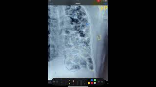 BRONCHIECTASIS FIBROSIS OF LUNGS MEDIASTINAL SHIFT X RAY CHEST [upl. by Evoy]