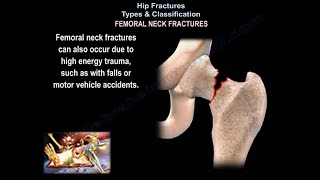 Hip Fractures Types amp Classifications  Everything You Need To Know  Dr Nabil Ebraheim [upl. by Einad158]