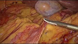 Laparoscopic assisted right hemicolectomy [upl. by Ttelrahc]