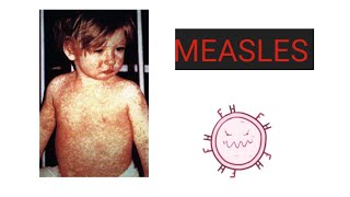 MEASLES Causes Pathology Symptoms Diagnosis Treatment Vaccination Care  What is Measles [upl. by Rives]