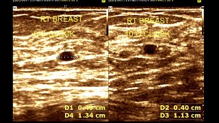 Multiple small hypoechoic and cystic mass  Cystic Lesion Breast [upl. by Etnemelc]