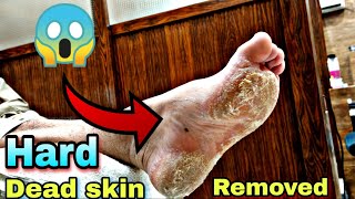 Dead skin Remove Pedicure Treatment of Foot 🔥  Footcare33 [upl. by Namaan961]