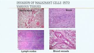 Squamous cell carcinoma and related lesions [upl. by Swanhildas115]