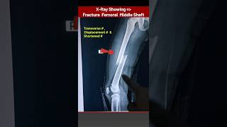 Thigh Bone Femur Fracture Xray xray radiology radiography bones Fracture radiographerusn [upl. by Ecinom]