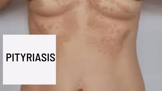 Pityriasis Causes Symptômes et diagnosticTraitements [upl. by Rowland]