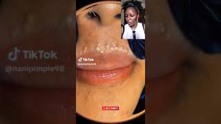 An Acne Sufferer REACTS to VIRAL TIKTOK PIMPLE POPPING VIDEO lip acne  Blackhead Extraction [upl. by Lotte]