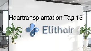 Das erwartet euch  14 Tage nach Haartransplanation bei Elithair [upl. by Anoirb]