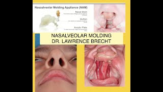 NASOALVEOLAR MOLDING 30 YEARS IN EVOLUTION [upl. by Lali]