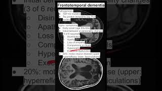 Frontotemporal dementia [upl. by Annahsar805]