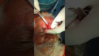 Forehead Cyst removal done under LA and suturing done with 20 vicryl kant eye care optometrist [upl. by Foote]