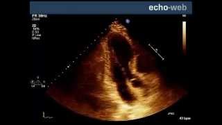 EchoWeb  Left Ventricular Akinesis [upl. by Bradshaw]