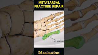 Metatarsal Fracture Repair Process shorts viral metatarsal fracture [upl. by Griffy191]