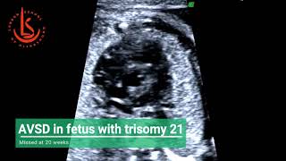 AVSD for fetus with Downs syndrome missed at 20 weeks scan [upl. by Schacker]