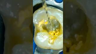 guttapercha Removal using Retreatment D1 D2  D3 Rotary files الكربولة [upl. by Selig]