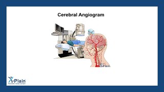 Cerebral Angiogram [upl. by Stanton]