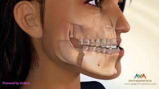 Surgical Orthodontic Treatment for Underbite or Crossbite  BSSO Mandibular Setback [upl. by Asena]