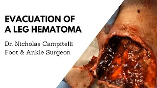 Surgical evacuation of a hematoma in a leg  Dr Nicholas A Campitelli [upl. by Ilenna]