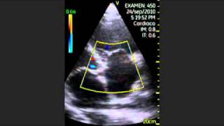 VSCAN Tricuspid insufficiency Pocket Ultrasound [upl. by Naesyar994]