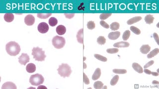 SpherocyteSpherocytosis ElliptocyteElliptocytosis Echinocyte Burr Cell Peripheral Blood Smears [upl. by Leisha]