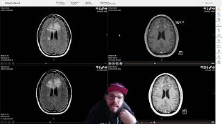 Hirntumor WHO Grade 4 Eine Zweite Biopsie steht bevor [upl. by Lounge]