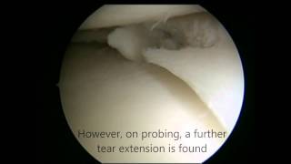 Knee Meniscal Tear Treatment  Keyhole Surgery Arthroscopy [upl. by Nyliak]