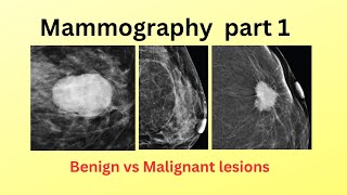 Mammography Part 1 [upl. by Hanikehs]