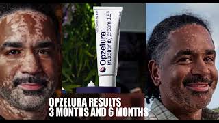 Vitiligo Treatment Results With Opzelura 36 Months [upl. by Demott]