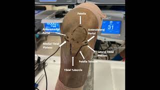 In Office Needle Arthroscopy of the Knee With Lateral Parapatellar Retinacular Release [upl. by Noit]