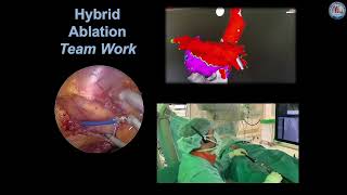 Hybrid atrial fibrillation ablation [upl. by Olifoet]