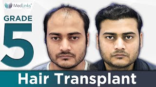 Hair Transplant Before amp After  6 Month Results  3500 Grafts transplanted in Front and Hairline [upl. by Ayat]