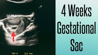 4 Weeks Pregnancy Scan  Gestational Sac on Ultrasound  Early Pregnancy Scan [upl. by Myrilla]