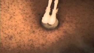 NonSurgical Keloid Treatment with Cryotherapy [upl. by Emmalyn]