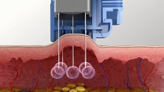 Meso Injector system for Mesotherapy Injection [upl. by Ytisahcal]