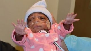 One of Worlds Smallest Premature Babies Leaves Hospital After Beating Odds [upl. by Vod]