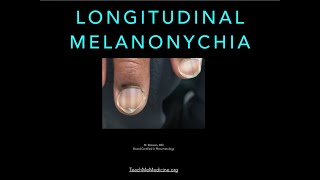 Nails Longitudinal Melanonychia [upl. by Alfonso]