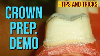 full metal crown preparation on molar demo [upl. by Jacinthe]