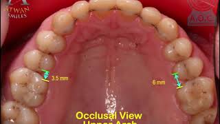 Amazing orthodontic treatment of Cl II div 2 with invisible braces  Omar 48 ys [upl. by Portingale]