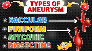 Understanding Types Of Aneurysm  Saccular  Fusiform  Mycotic  Dissecting 😍 [upl. by Nytsrik]