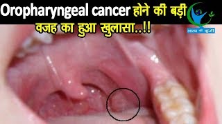 Oropharyngeal Cancer मुख और गले के कैंसर मरीजों के आंकड़ों को सुनकर दंग रह जायेंगे लक्षण और उपचार [upl. by Tj212]