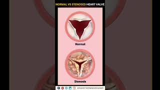 Normal vs Narrowed Stenosed Heart Valve education neet biology heart [upl. by Nichola]