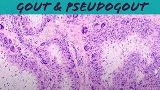 Gout amp Pseudogout calcium pyrophosphate deposition disease  chondrocalcinosis pathology USMLE [upl. by Kentiggerma358]