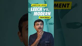 Can Leech Therapy REALLY Cure Varicose Veins [upl. by Gnilrac263]