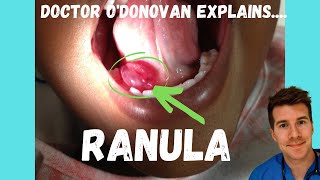 Explaining a Ranula or Mucocele  With Dr ODonovan [upl. by Atinrehs]