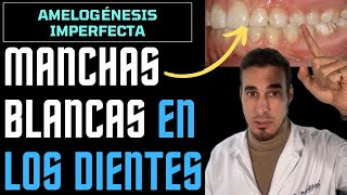 MANCHAS BLANCAS en los DIENTES  Amelogénesis imperfecta o hipoplasia de esmalte [upl. by Aluor]