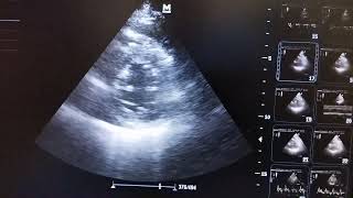 Global Hypokinesia of left ventricle [upl. by Veradia]