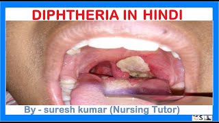 डिप्थीरिया क्या है  DIPHTHERIA IN HINDI  डिप्थीरिया से बच्चों का बचाव कैसे करें [upl. by Abbate]