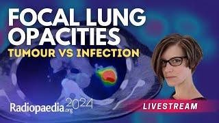 Focal lung opacities tumour vs infection with​ Miranda Siemienowicz [upl. by Sandry]