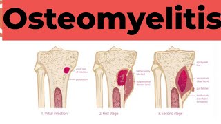 Osteomyelitis  Causes Sign and Symptoms Diagnosis amp Treatment Pathology [upl. by Miru]