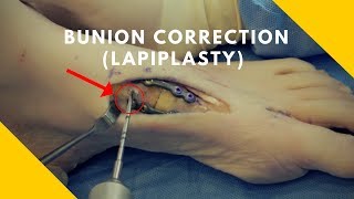 Full Bunion Correction  Lapiplasty Procedure Demonstration [upl. by Ebsen]