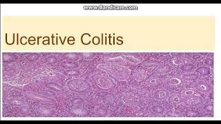 Ulcerative colitis  Morphology Clinical features difference from Crohn disease [upl. by Reddy]